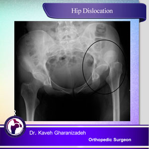 hip dislocation