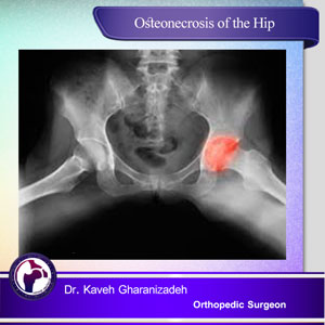 osteonecrosis of the hip