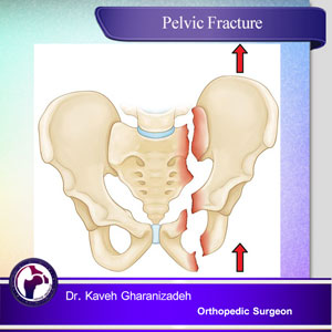 pelvic fracture